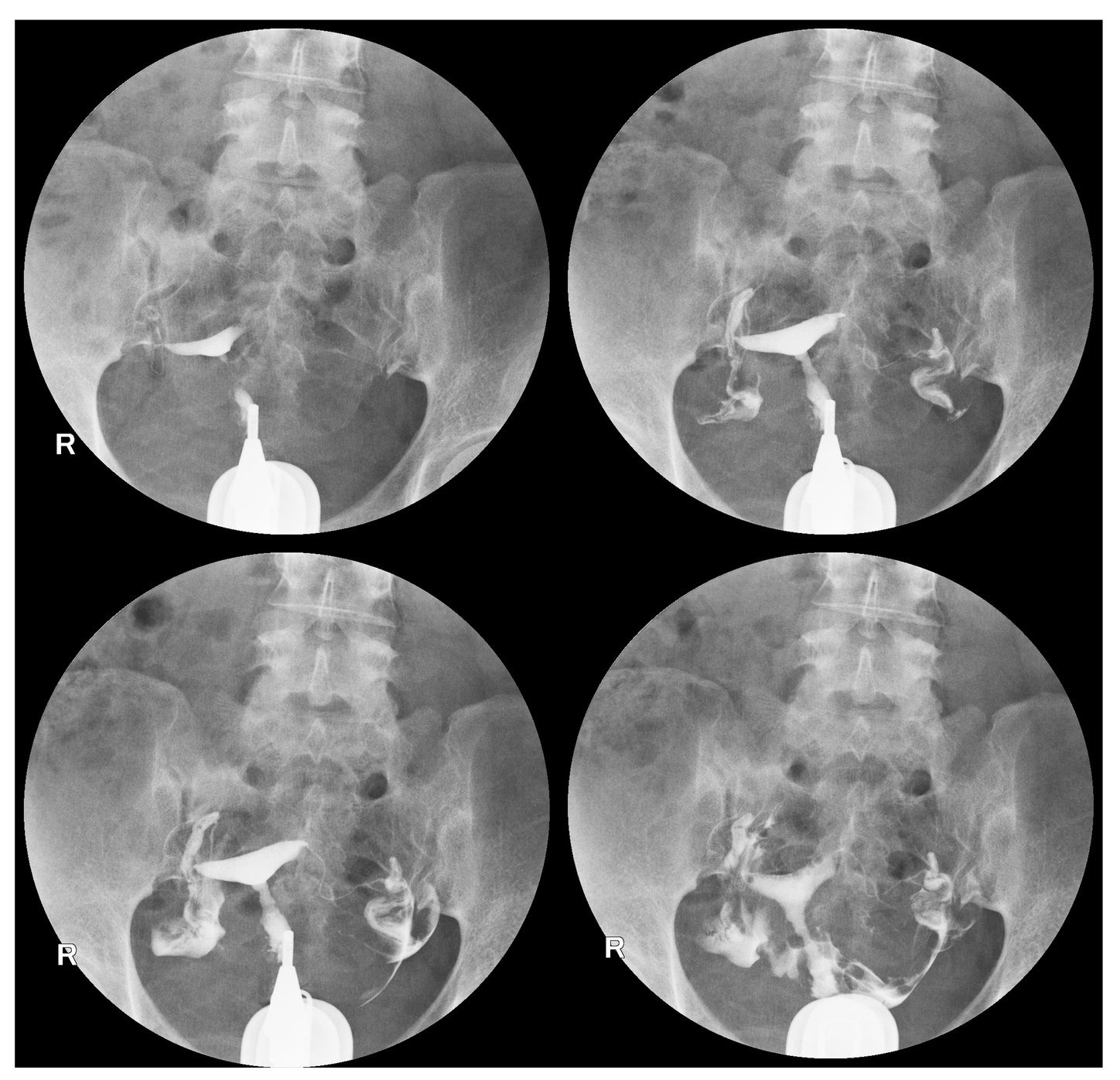 hysterosalpingography radiology The uterus is normal size and shape.