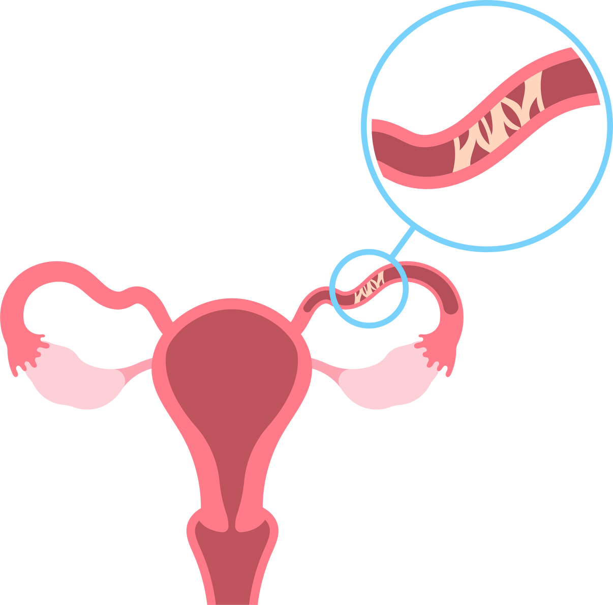 pelvis pain blocked Tubal ligation surgery uterus sperm fertilizes female women PCOS IVF In Vitro Fertilization period